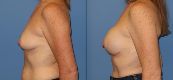 Before & After Breast Reconstruction Case 19 Left Side View in Charleston, SC