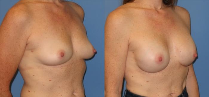Before & After Breast Reconstruction Case 19 Right Oblique View in Charleston, SC