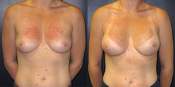 Before & After Breast Reconstruction Case 20 Front View in Charleston, SC