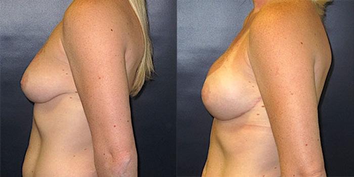 Before & After Breast Reconstruction Case 20 Left Side View in Charleston, SC