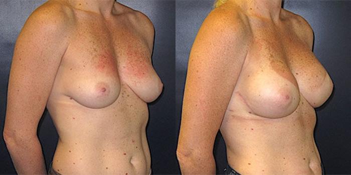 Before & After Breast Reconstruction Case 20 Right Oblique View in Charleston, SC