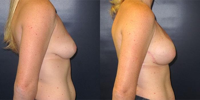Before & After Breast Reconstruction Case 20 Right Side View in Charleston, SC