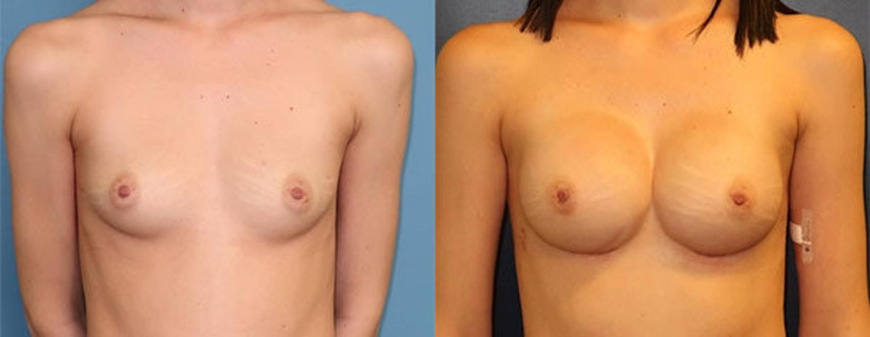 Before & After Breast Reconstruction Case 21 Front View in Charleston, SC