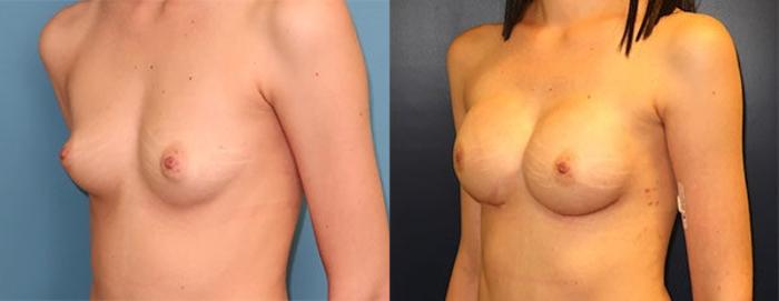 Before & After Breast Reconstruction Case 21 Left Oblique View in Charleston, SC