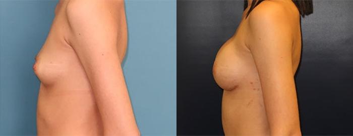 Before & After Breast Reconstruction Case 21 Left Side View in Charleston, SC