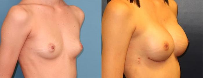Before & After Breast Reconstruction Case 21 Right Oblique View in Charleston, SC