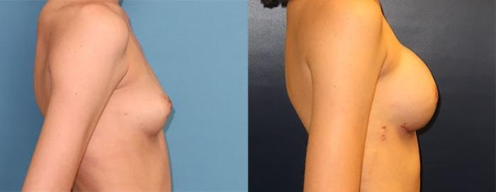 Before & After Breast Reconstruction Case 21 Right Side View in Charleston, SC