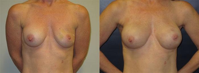 Before & After Breast Reconstruction Case 22 Front View in Charleston, SC