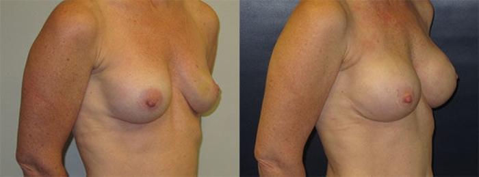 Before & After Breast Reconstruction Case 22 Right Oblique View in Charleston, SC