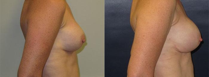 Before & After Breast Reconstruction Case 22 Right Side View in Charleston, SC