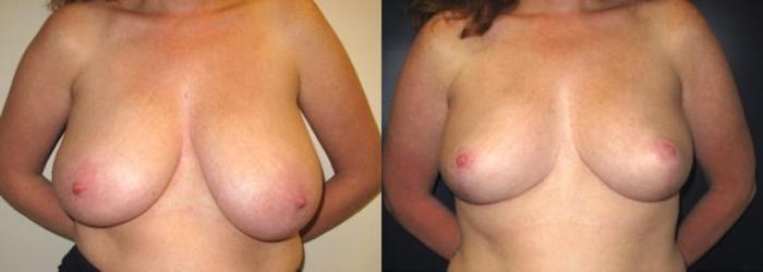 Before & After Breast Reduction Case 17 Front View in Charleston, SC