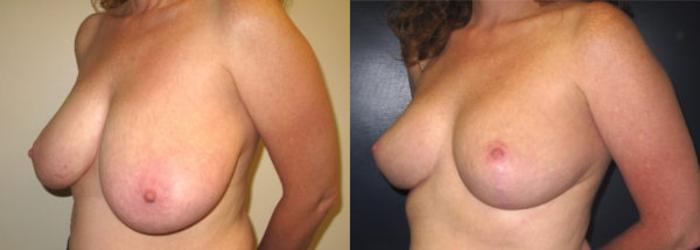 Before & After Breast Reduction Case 17 Left Oblique View in Charleston, SC