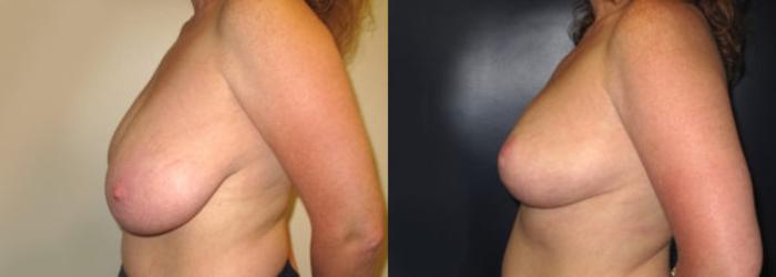 Before & After Breast Reduction Case 17 Left Side View in Charleston, SC