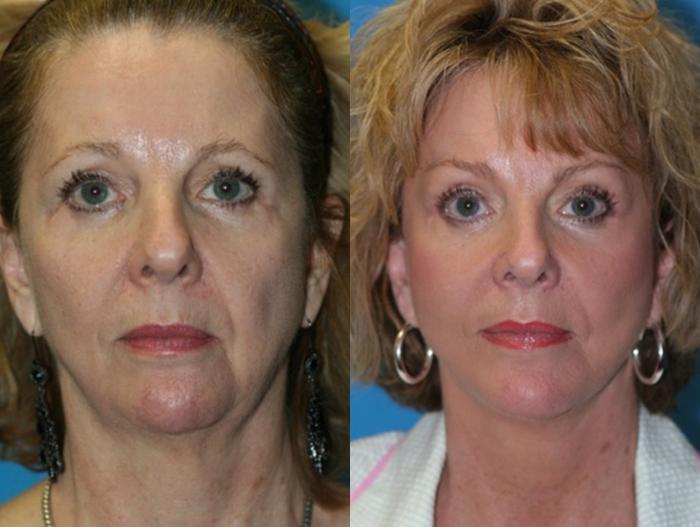Before & After Chin Augmentation Case 39 Front View in Charleston, SC