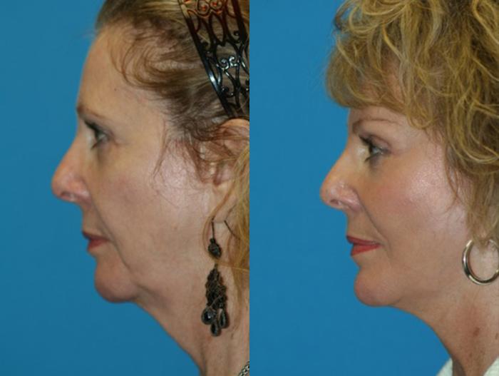 Before & After Chin Augmentation Case 39 Left Side View in Charleston, SC