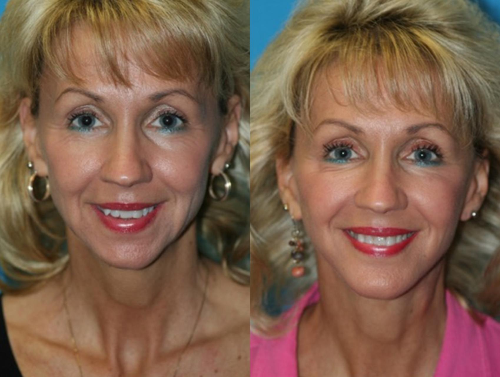 Before & After Chin Augmentation Case 40 Front View in Charleston, SC