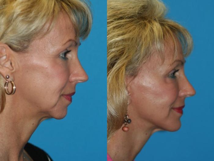 Before & After Chin Augmentation Case 40 Right Side View in Charleston, SC