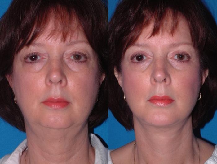 Before & After Chin Augmentation Case 41 Front View in Charleston, SC