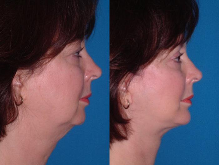 Before & After Chin Augmentation Case 41 Right Side View in Charleston, SC
