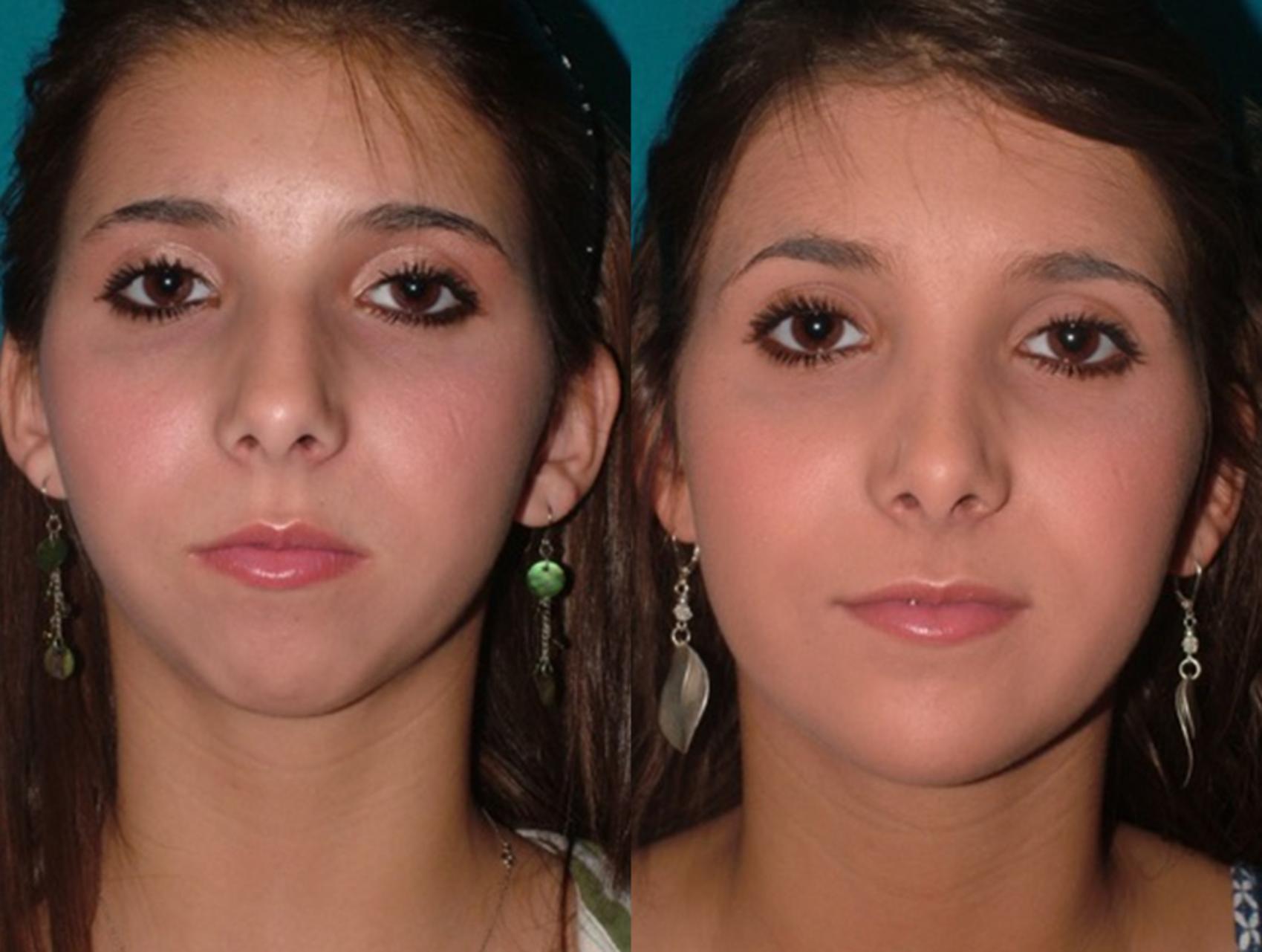 Before & After Chin Augmentation Case 42 Front View in Charleston, SC