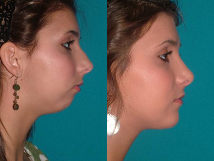 Before & After Chin Augmentation Case 42 Right Side View in Charleston, SC