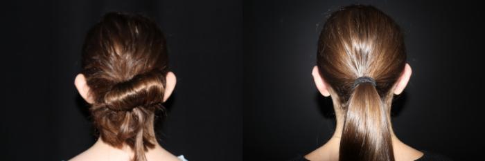 Before & After Ear Surgery (Otoplasty) Case 155 Back View in Charleston, SC