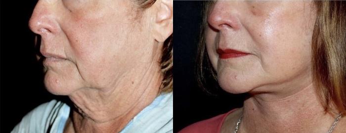 Before & After Neck Lift Case 117 Left Oblique View in Charleston, SC