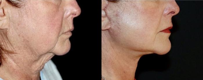 Before & After Neck Lift Case 117 Right Side View in Charleston, SC