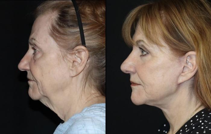 Before & After Rhinoplasty Case 118 Left Side View in Charleston, SC