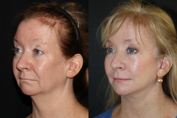 Before & After Brow Lift Case 152 Right Oblique View in Charleston, SC