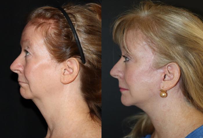 Before & After Brow Lift Case 152 Right Side View in Charleston, SC