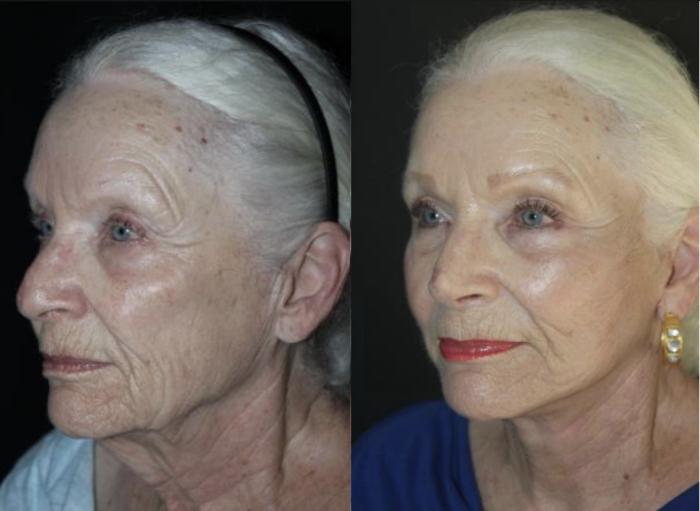 Before & After Facelift Case 153 Left Oblique View in Charleston, SC