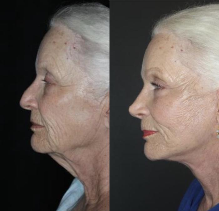 Before & After Rhinoplasty Case 153 Left Side View in Charleston, SC