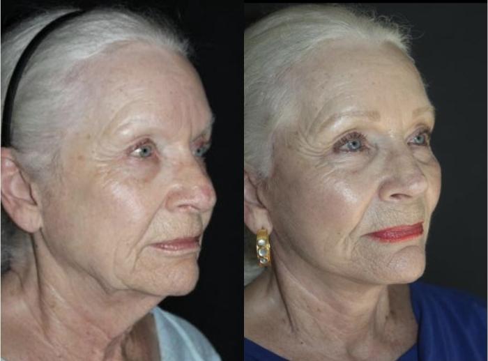 Before & After Facelift Case 153 Right Oblique View in Charleston, SC