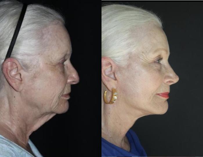 Before & After Facelift Case 153 Right Side View in Charleston, SC