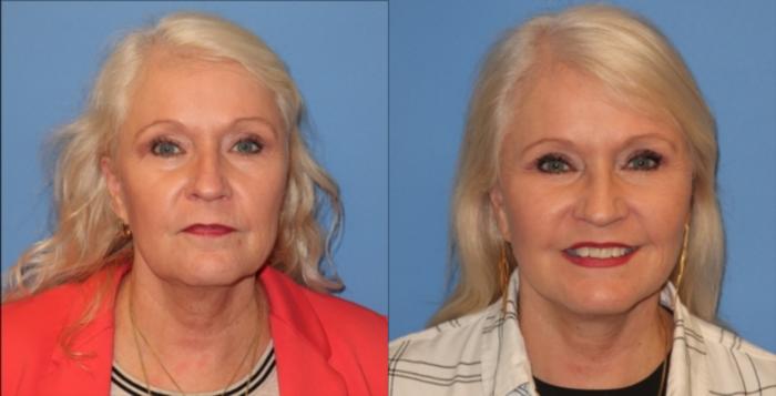 Before & After Facelift Case 33 Front with Smile View in Charleston, SC