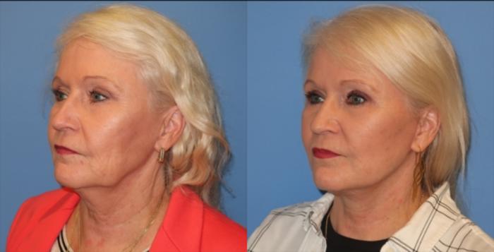 Before & After Neck Lift Case 33 Left Oblique View in Charleston, SC