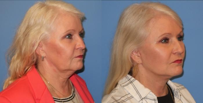 Before & After Facelift Case 33 Right Oblique View in Charleston, SC