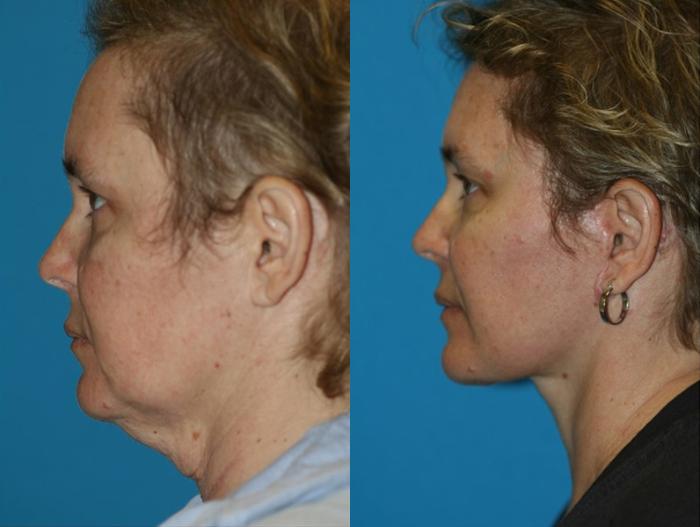 Before & After Facelift Case 5 Left Side View in Charleston, SC
