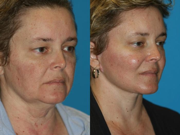 Before & After Facelift Case 5 Right Oblique View in Charleston, SC