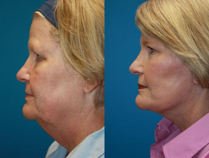 Before & After Facelift Case 50 Left Side View in Charleston, SC
