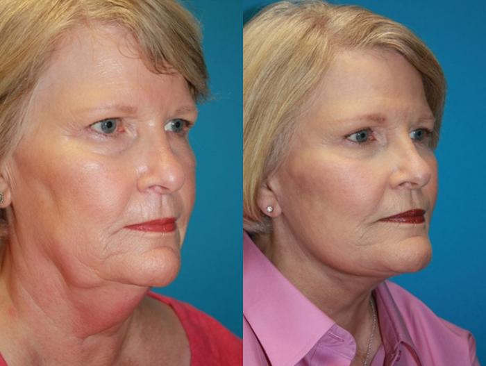 Before & After Facelift Case 50 Right Oblique View in Charleston, SC