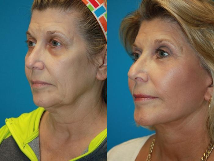 Before & After Facelift Case 51 Left Oblique View in Charleston, SC