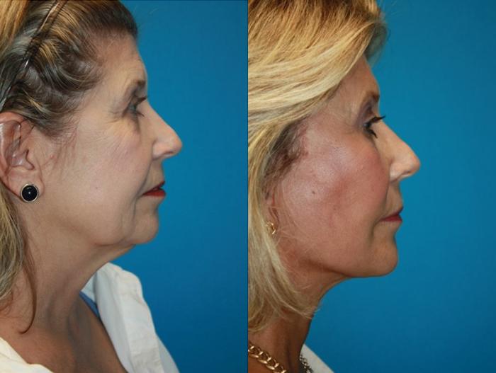 Before & After Facelift Case 51 Right Side View in Charleston, SC