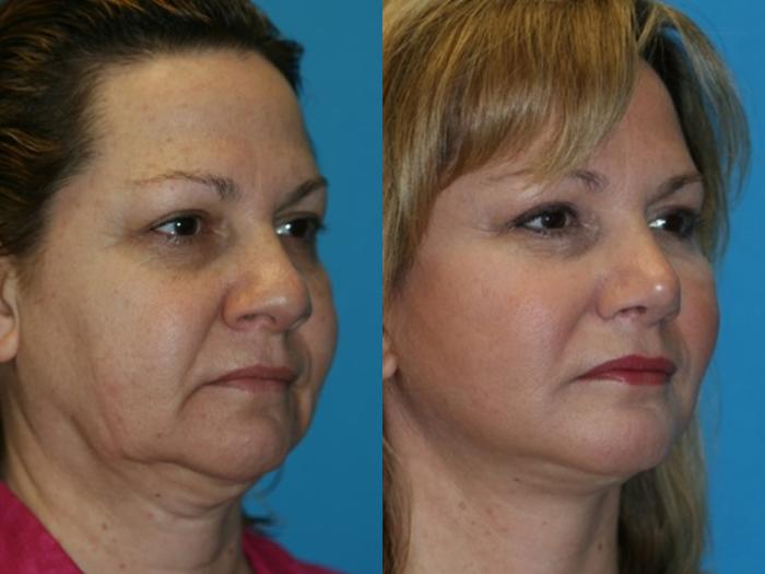 Before & After Facelift Case 52 Right Oblique View in Charleston, SC