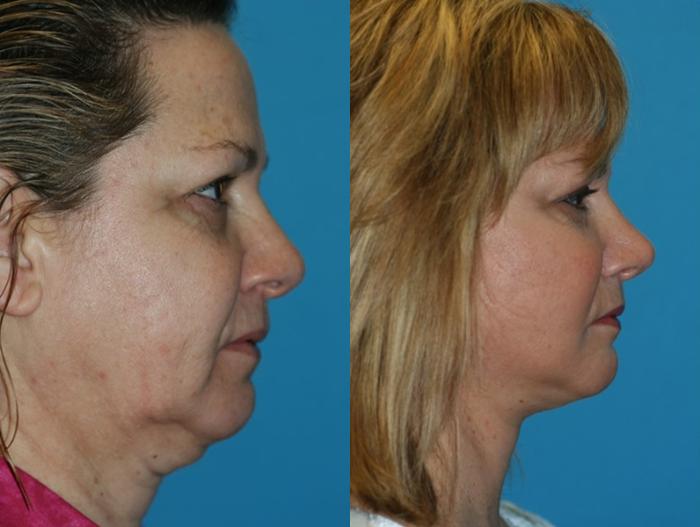 Before & After Facelift Case 52 Right Side View in Charleston, SC