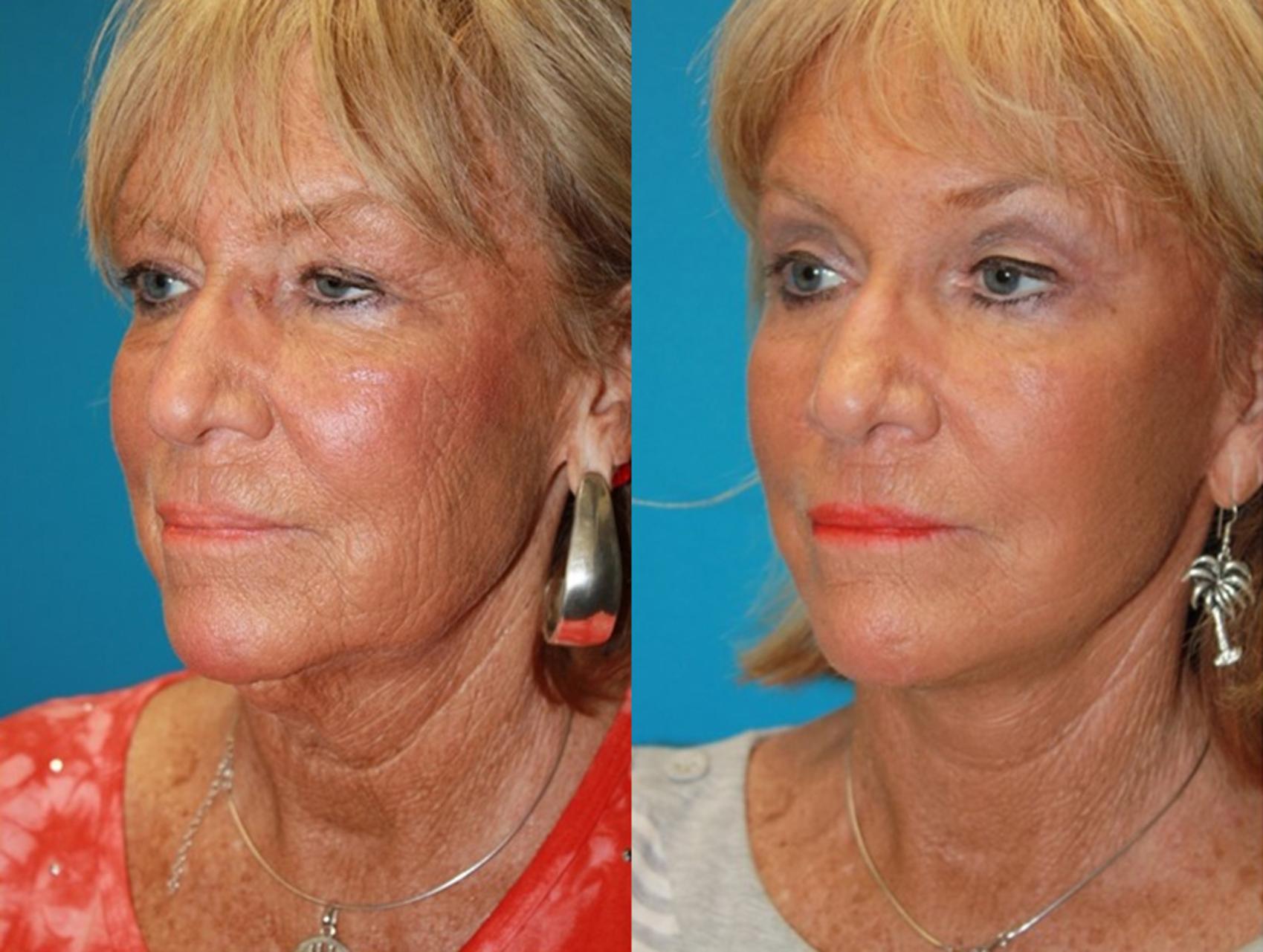 Before & After Facelift Case 53 Left Oblique View in Charleston, SC