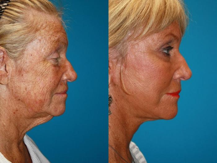 Before & After Facelift Case 53 Right Side View in Charleston, SC