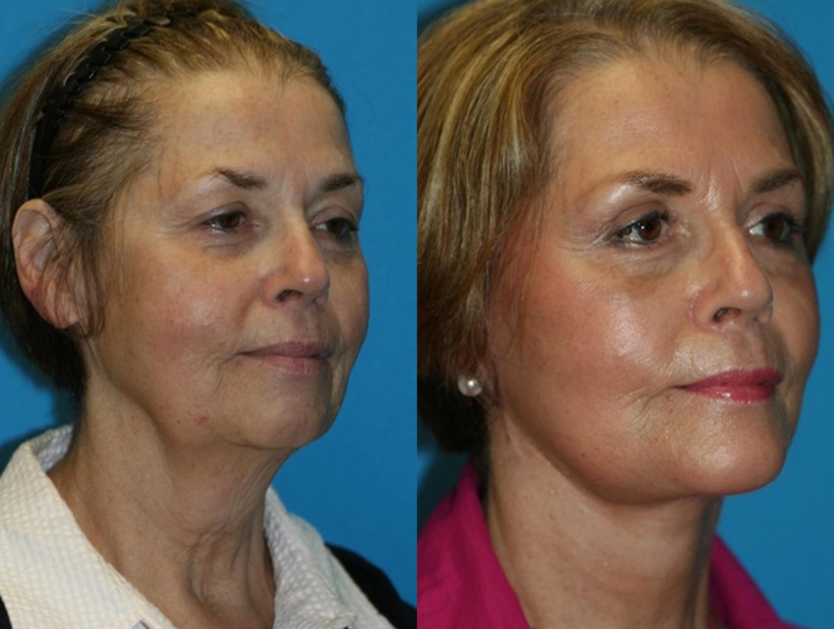 Before & After Facelift Case 54 Right Oblique View in Charleston, SC