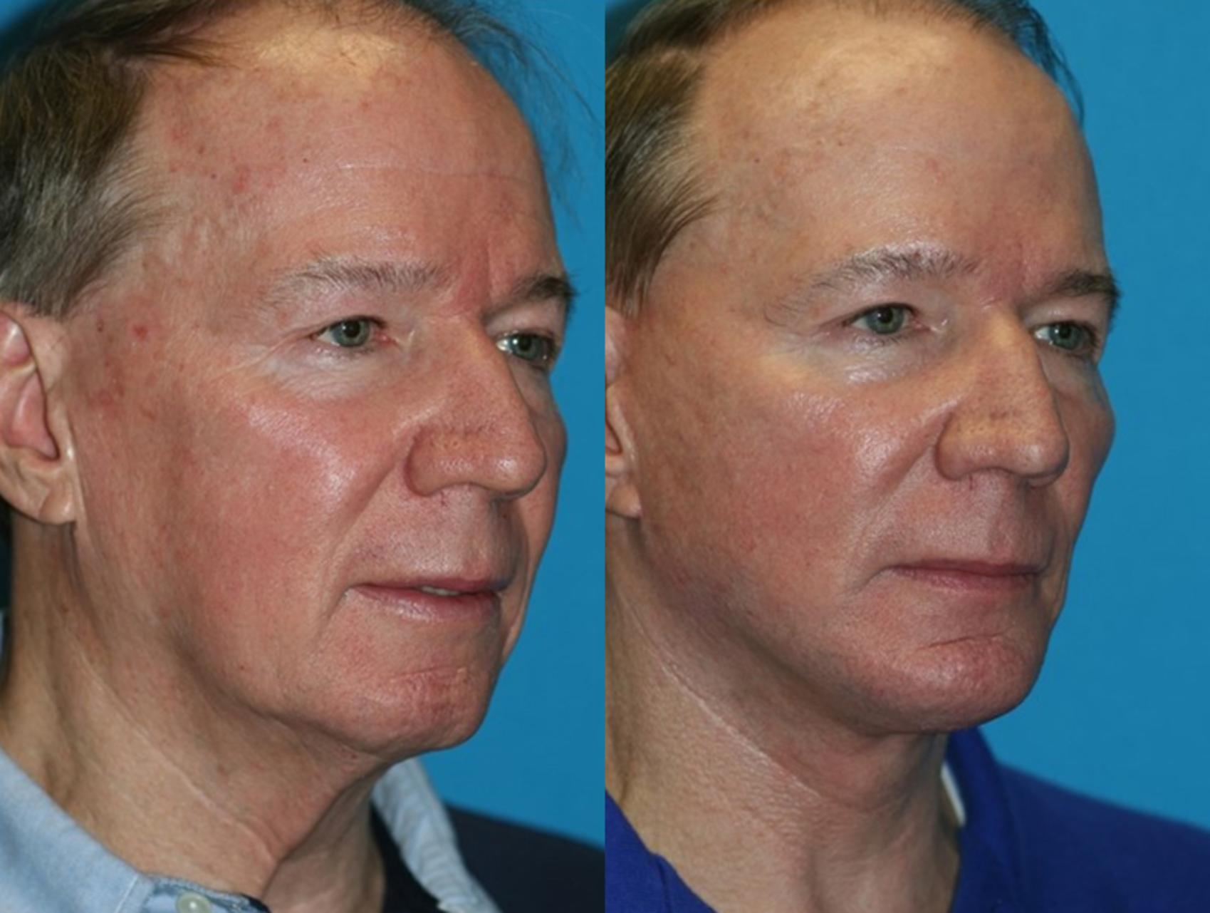 Before & After Facelift Case 55 Right Oblique View in Charleston, SC